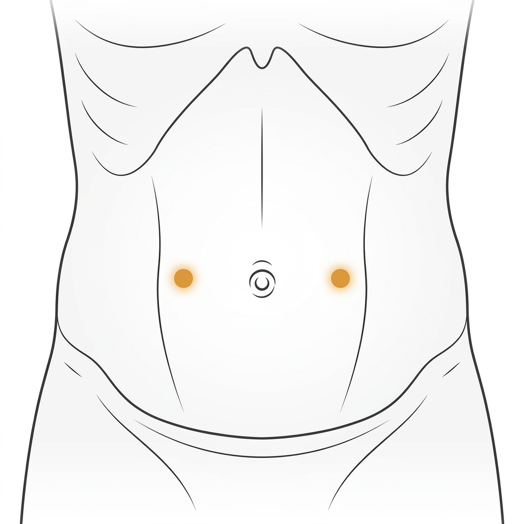 A medical illustration showing the ST25 acupressure points located two finger-widths on either side of the belly button.
